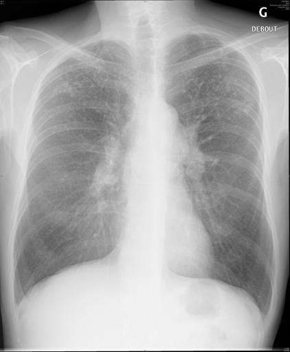 Miliaire pulmonaire dans le cadre d'une sarcoïdose