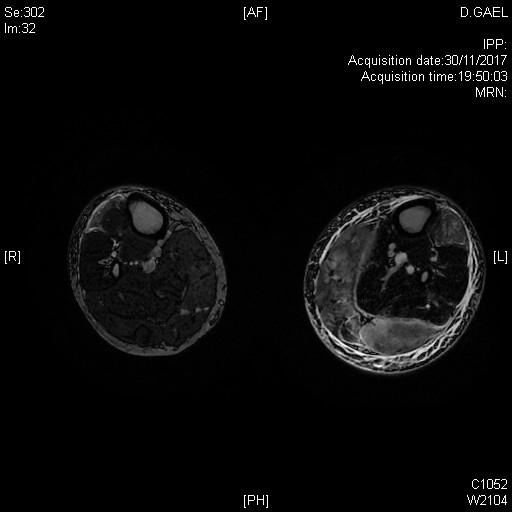 Hypersignaux T2 des muscles de la jambe dans le cadre d'un tableau clinique de dermatomyosite à auto-anticorps négatifs, révélée par une atteinte brutale oedémateuse