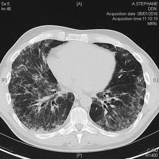 Pneumopathie interstitielle dans le cadre d'une myopathie inflammatoire à anticorps anti-MDA5