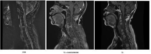 Spondylodiscite multifocale du rachis cervical et du rachis dorsal