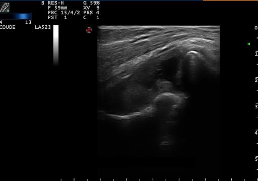 Synovite du coude dans le cadre d'une polyarthrite rhumatoïde évoluée