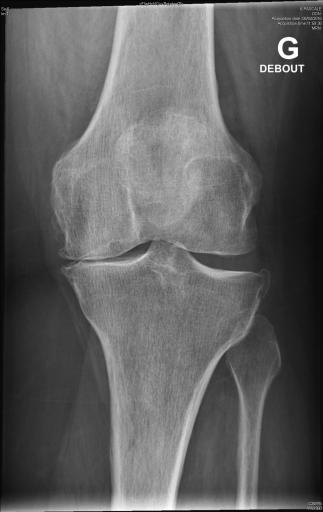 Gonarthrose évoluée sur terrain d'obésité