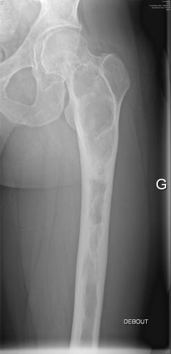 Dysplasie fibreuse du fémur gauche dans un contexte de dysplasie fibreuse polyostotique