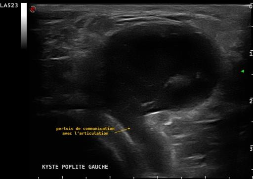 Volumineux kyste poplité symptomatique visualisé en échographie