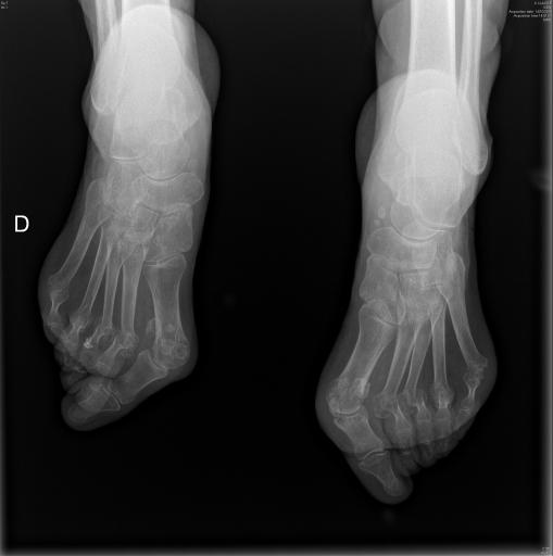 Polyarthrite rhumatoïde séropositive, sévèrement érosive aux pieds