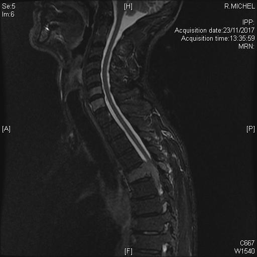 Multiples lésions vertébrales rachidiennes avec compression médullaire et épidurite à l'étage T5, dans le cadre d'un cancer pulmonaire, en séquence T2 STIR