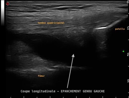 Epanchement intra-articulaire du genou, visible en échographie, dans le cadre d'une arthrite