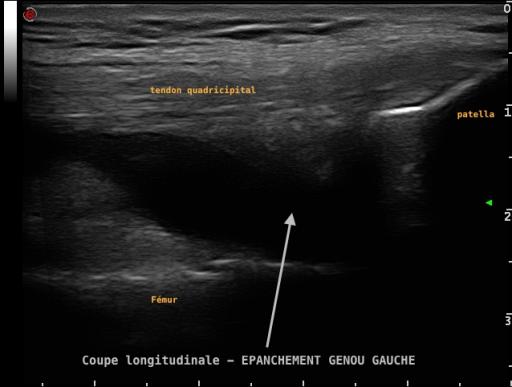 Epanchement intra-articulaire du genou, visible en échographie, dans le cadre d'une arthrite