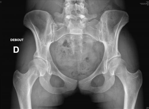Radiographie retrouvant une dysplasie acétabulaire bilatérale ainsi qu'une lésion de dysplasie fibreuse du col fémoral droit chez une jeune fille