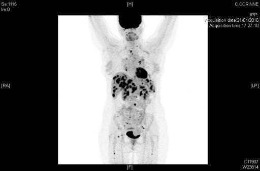 Atteintes systémiques diffuses dans le cadre d'une sarcoïdose (TEP-scan)