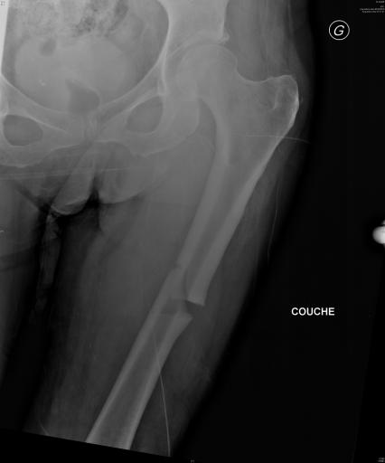 Fracture fémorale atypique sous biphosphonates