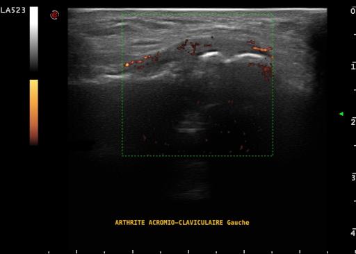 Arthrite acromio-claviculaire gauche en échographie, dans le cadre d'une infection à pyogène