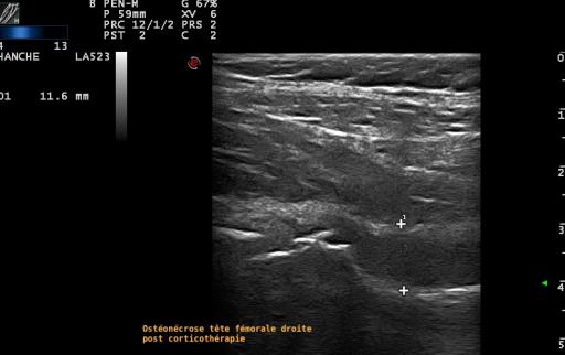 Aspect échographique d'une ostéonecrose aseptique de la tête fémoral avec épanchement associé, chez une jeune fille, dans un contexte de corticothérapie dans le cadre d'une hémopathie