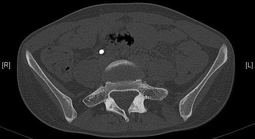 Spina bifida occulta