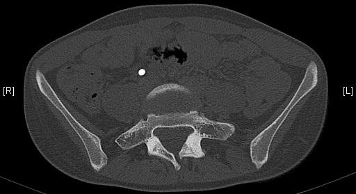 Spina bifida occulta