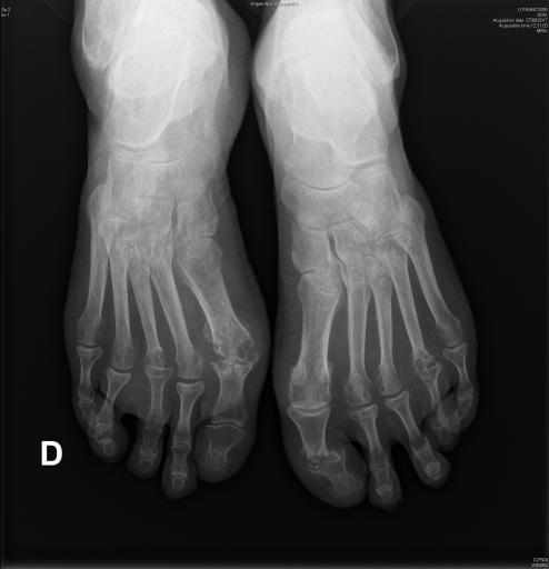 Polyarthrite rhumatoïde séropositive, sévèrement érosive aux pieds