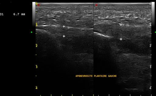 Aponévrosite plantaire gauche symptomatique confirmée par l'échographie