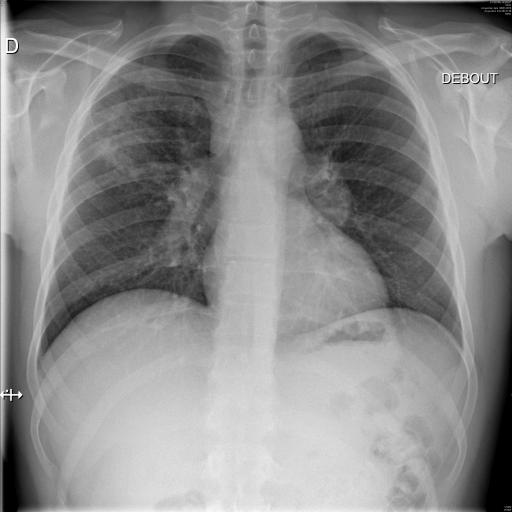 Syndrome interstitiel et adénopathies médiastinales dans le cadre d'une sarcoïdose systémique